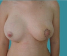 Lifting dei seni con protesi - Sindrome di Poland, protesi rotonda 300 seno destro, mamopexia seno sinistro - Dopo 